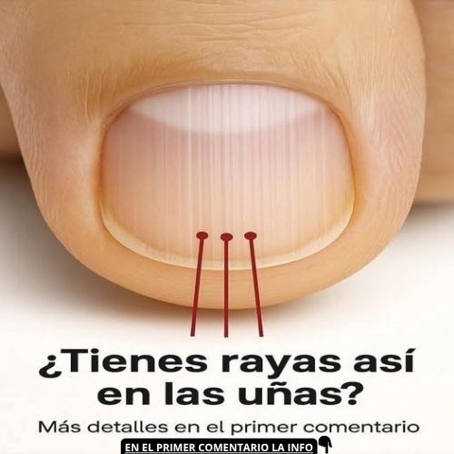 Rayas en las uñas