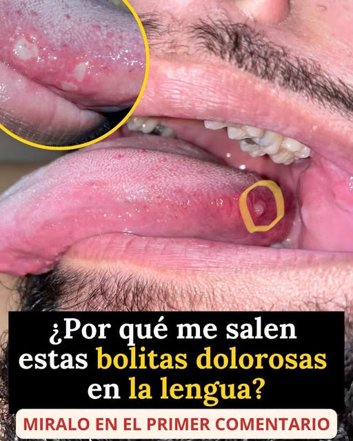 bolitas dolorosas en la lengua