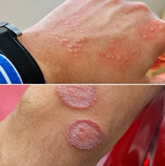 Culebrilla o herpes zóster