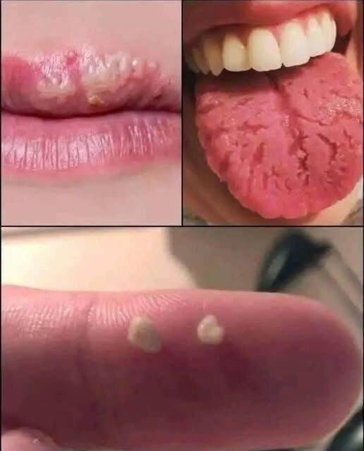 Bolitas con mal olor en la garganta: causas, síntomas y prevención