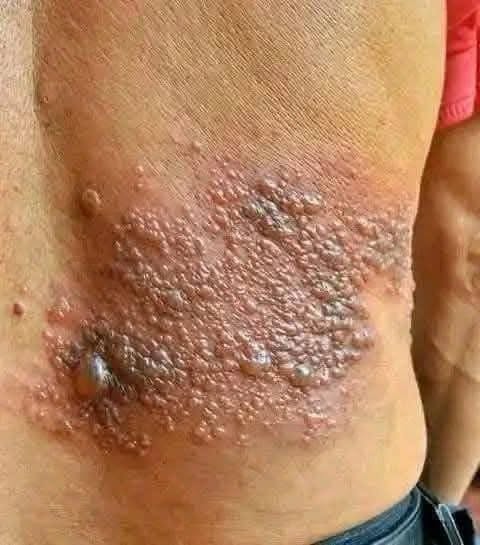 Síntomas de la culebrilla: cómo reconocer el herpes zóster a tiempo