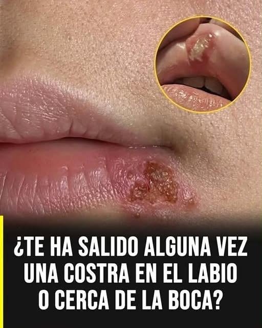 Herpes labial: cómo prevenir los brotes y proteger tus labios