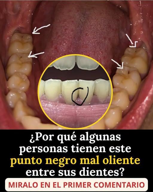 Puntos negros en las muelas: cuándo pueden indicar una caries